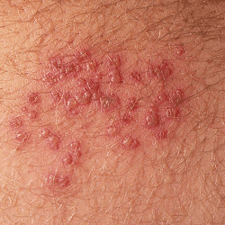 Genitalis frau herpes : Herpes